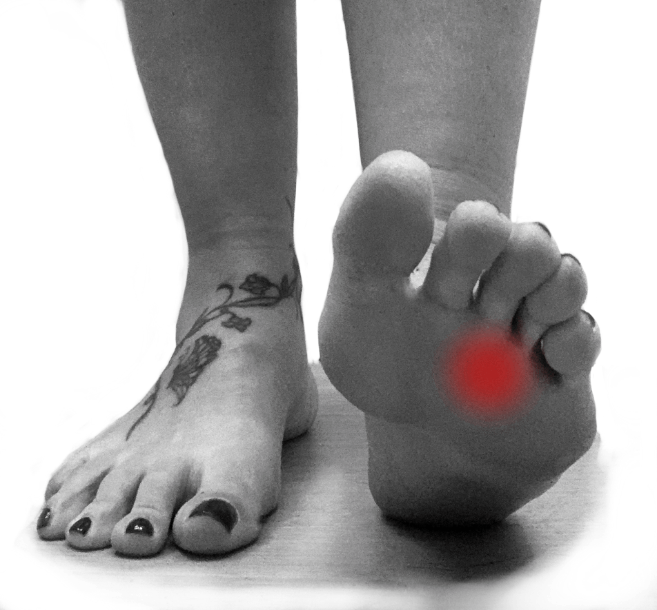 Neuroma di Morton